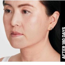 Ultherapy Before & After Patient #1544